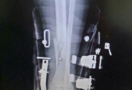 韓喬生滑雪 骨折