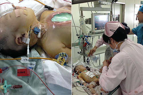 12天男嬰命懸一線 青島救活了！